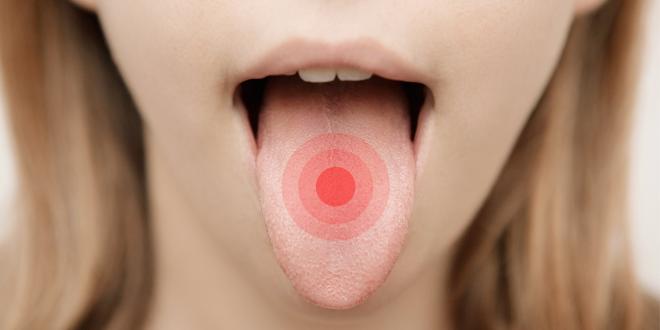 Schmerzen der Zunge
