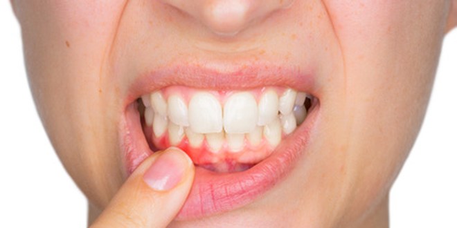 Frau zeigt auf ihre Lippe und zeigt Zähne