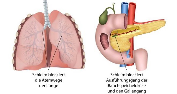 Zystische Fibrose