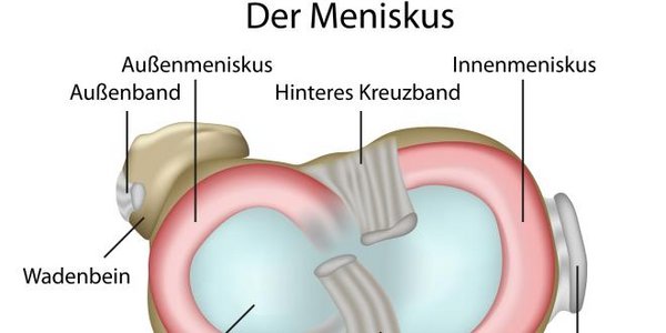 Lateraler Meniskus