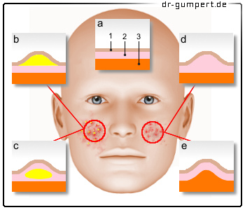 Rote Flecken Im Gesicht Ursachen Und Behandlung