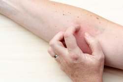 Hautausschlag Diese Erkrankungen Stecken Dahinter