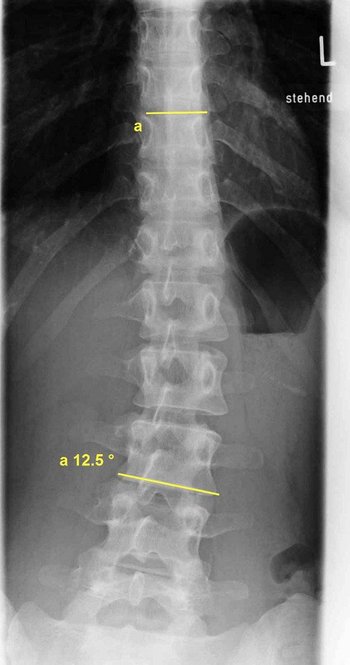 Röntgenbild Skoliose LWS